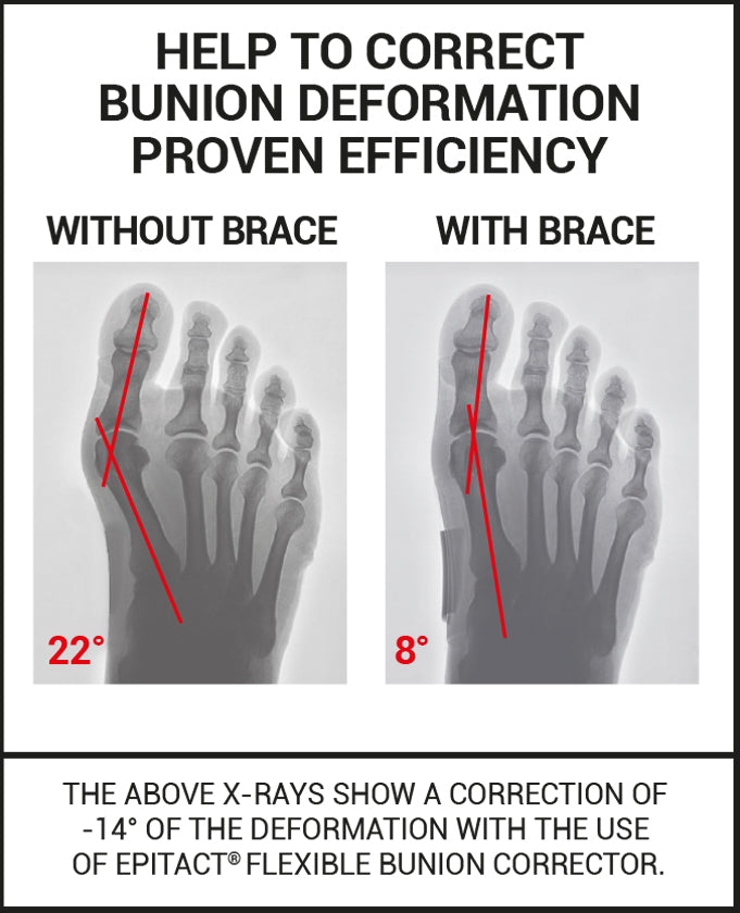 Epitact - Bunion Brace - Day - Hallux Valgus Corrective Brace